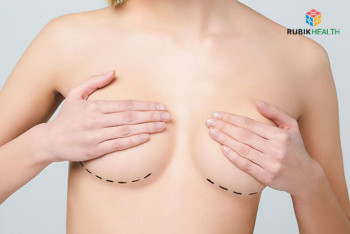 Breast Augmentation with round implants (Mentor Silicone) - Less then 400 ml.