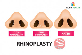 Open Rhinoplasty - US Silicone