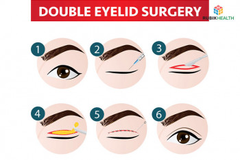 Double Eyelid Surgery (Short incision)