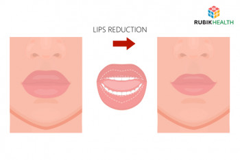 Lip Reduction (One Side)