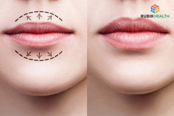 Lip reduction (Both Sides)
