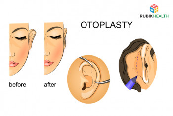 Otoplasty (2 side)