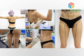 Vaser Liposuction (For 1 Individual Area)