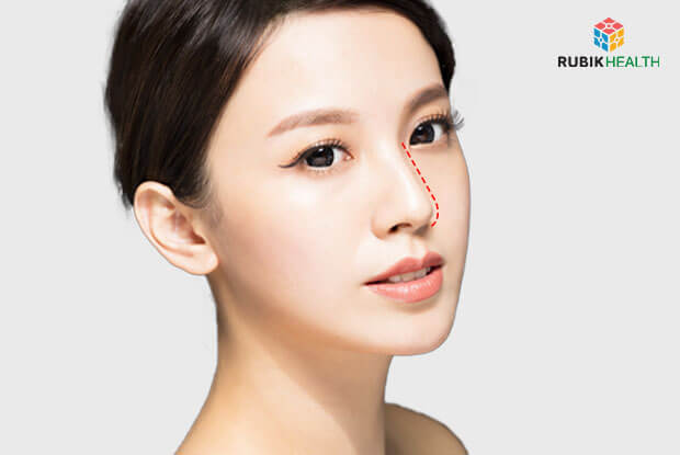 Soft Nose Implant (Korea)