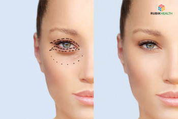 Upper OR Lower eyelid surgery (plus other surgery under GA)