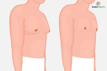 Male Breast Reduction - Male Chest Vaser Liposuction