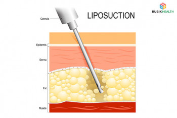 Vaser Liposuction (first two point)