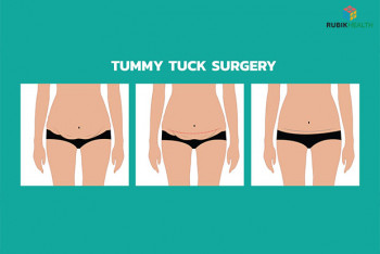 Lipectomy (Tummy Tuck)