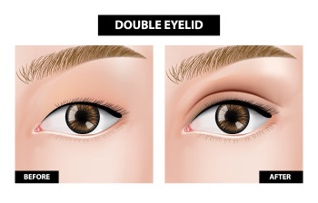 Double eyelid (Japan style) 3 dots