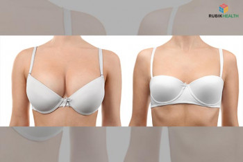 Women Breast Reduction  + Breast lift