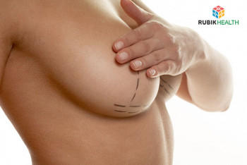 Breast Augmentation - Tear Drop Shape (Mentor Brand)