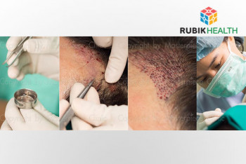 Hair Transplant (Package Price for NOT over than 1,000 grafts)
