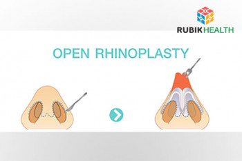 Nose Reconstruction (Open Rhinoplasty)