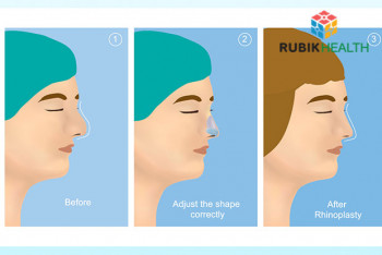 Nose Augmentation Using Rib 
Cartilage