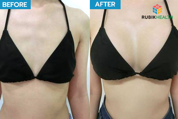Safety breast augmentation surgery with BB Clinic
