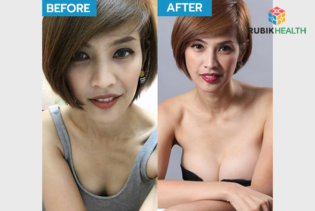 Beautiful Breasts Make Good Life At Apex Medical Center