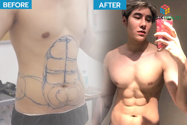 The Six-pack abs surgery by Masterpiece Hospital